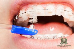 A má higiene dentária provoca a inflamação da gengiva (gengivite), podendo evoluir para um estágio mais avançado que é a periodontite